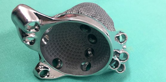 Ma&szlig;geschneidertes Implantat aus dem 3-D-Drucker (Foto: Helios Eisleben)