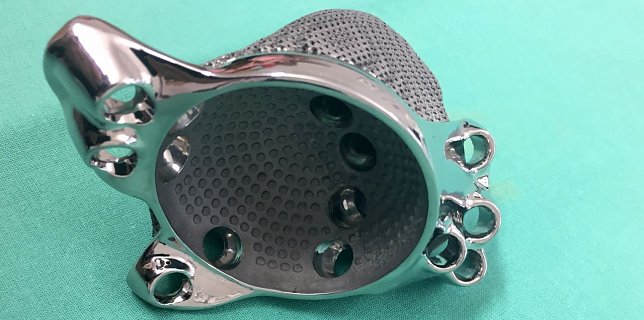 Bild: Ma&szlig;geschneidertes Implantat aus dem 3-D-Drucker